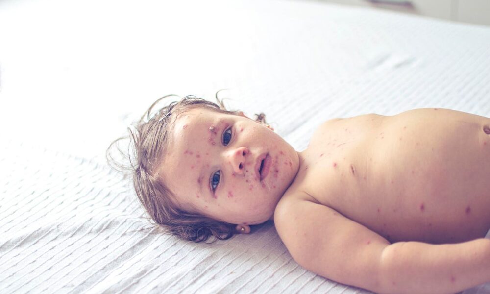 Alarming outbreaks of measles are increasing in Europe and Central Asia