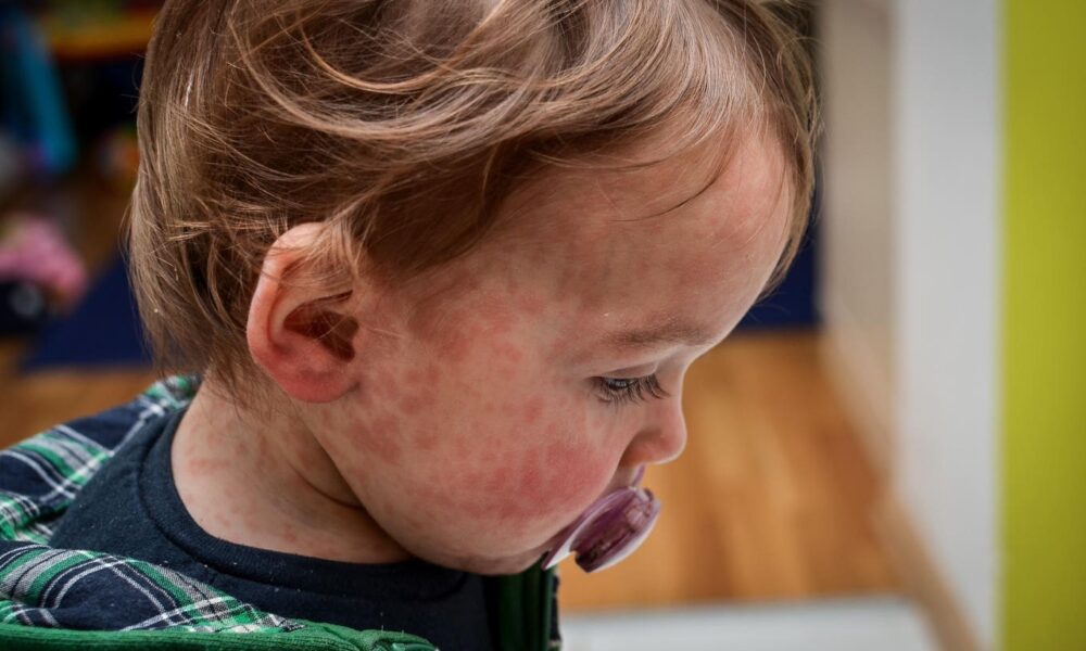 Measles outbreak reported in London as Britain sees continued rise in cases