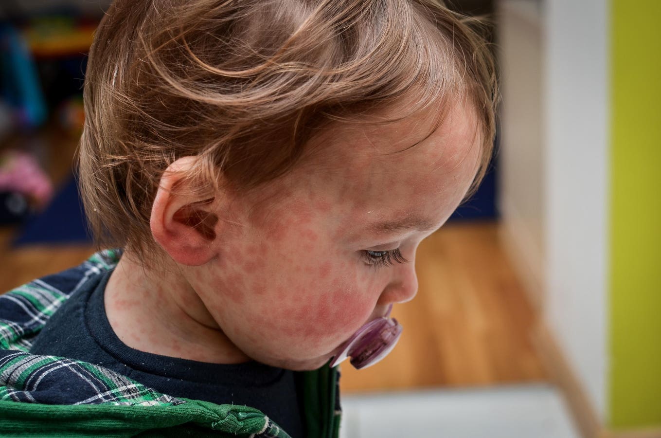 Measles outbreak reported in London as Britain sees continued rise in cases