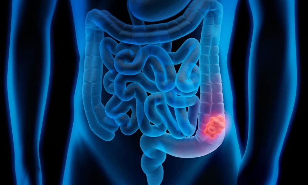 Phase 2 study shows that Opdivo-Yervoy is highly effective against colon cancer