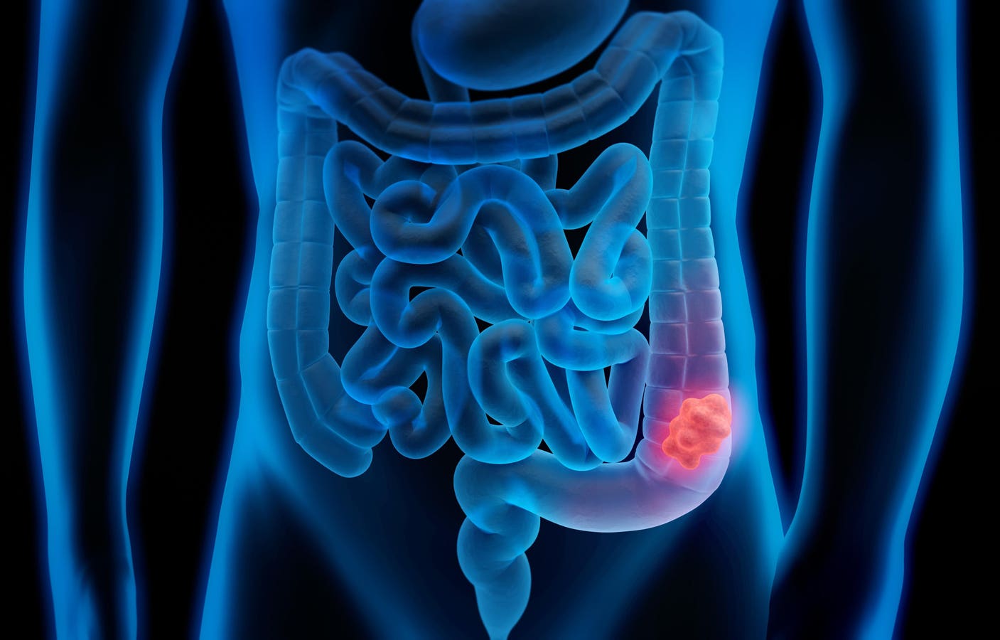 Phase 2 study shows that Opdivo-Yervoy is highly effective against colon cancer