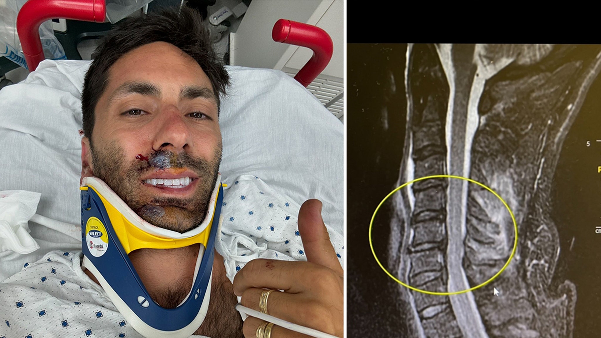 Nev Schulman breaks neck in bicycle accident